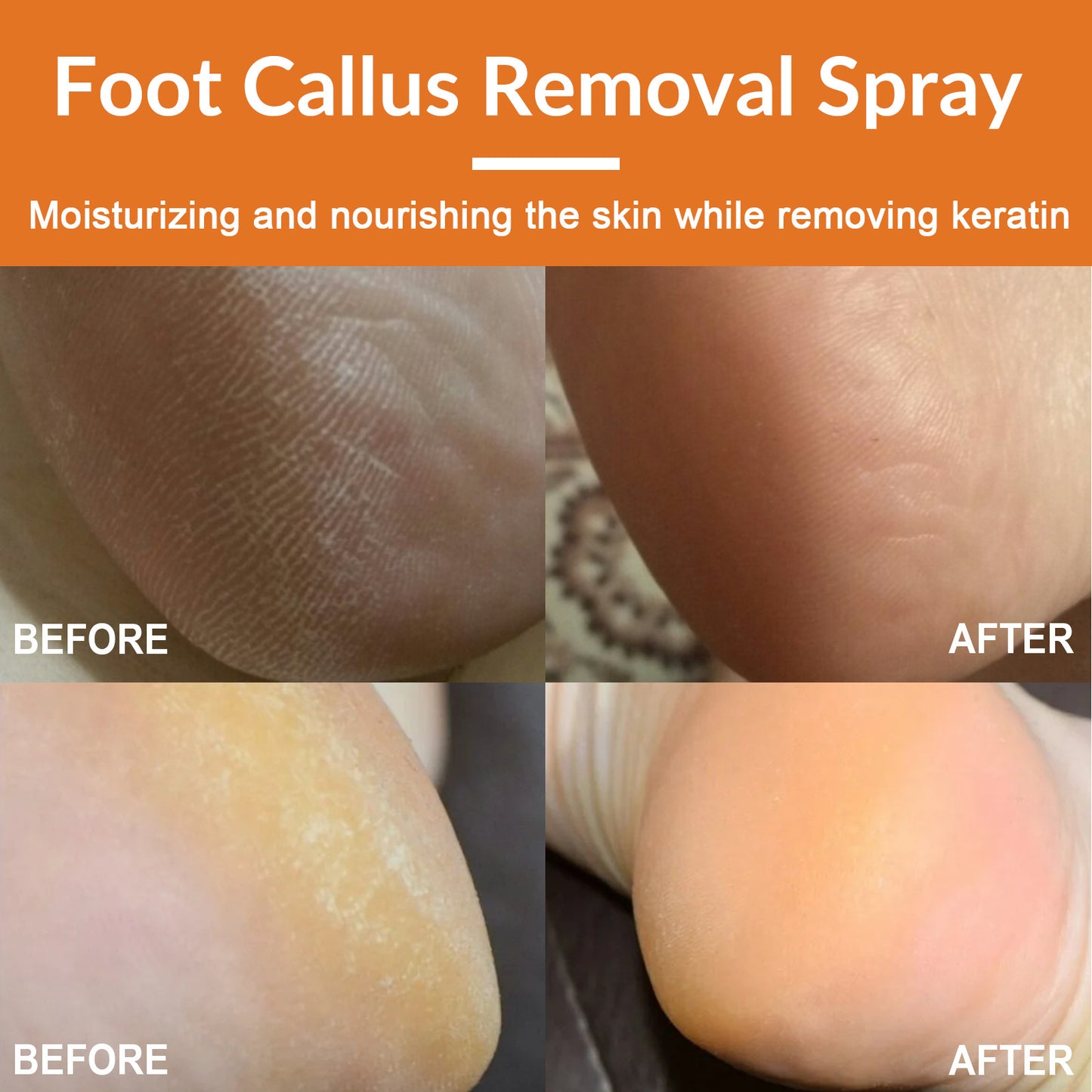 South Moon Foot Exfoliating Spray for Dead Skin, Cracked Skin, Moisturizing, Cleansing, Repairing, Roughness and Callus Removal